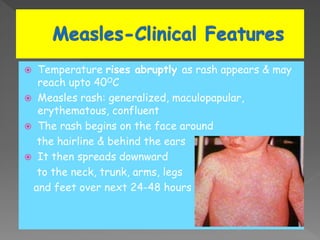  Temperature rises abruptly as rash appears & may
reach upto 40OC
 Measles rash: generalized, maculopapular,
erythematous, confluent
 The rash begins on the face around
the hairline & behind the ears
 It then spreads downward
to the neck, trunk, arms, legs
and feet over next 24-48 hours
 