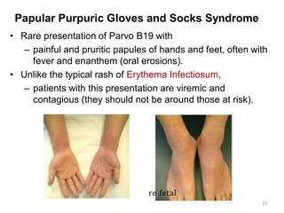 Parvovirus Hand Rash Viral Exanthems 2024(1).pdf weeqrrqgggqg | PDF