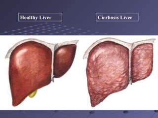 Healthy Liver Cirrhosis Liver
 