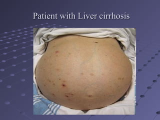 Patient with Liver cirrhosisPatient with Liver cirrhosis
 