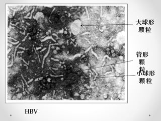 HBV
大球形
粒颗
管形
颗
粒
小球形
粒颗
 