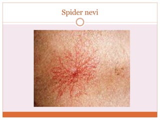 Spider nevi
 