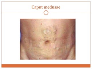 Caput medusae
 
