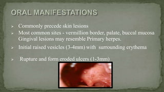  Commonly precede skin lesions
 Most common sites - vermillion border, palate, buccal mucosa
Gingival lesions may resemble Primary herpes.
 Initial raised vesicles (3-4mm) with surrounding erythema
 Rupture and form eroded ulcers (1-3mm)
 