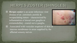  Herpes zoster is an acute infectious viral
disease of an extremely painful &
incapacitating nature - characterized by
inflammation of dorsal root ganglia or
extramedullary cranial nerve ganglia.
 Associated with vesicular eruptions of skin or
mucous membranes in areas supplied by the
affected sensory nerves.
 