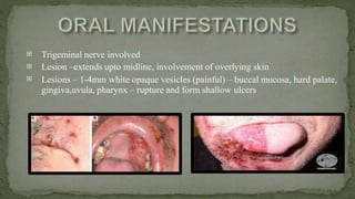 


Trigeminal nerve involved
Lesion –extends upto midline, involvement of overlying skin
Lesions – 1-4mm white opaque vesicles (painful) – buccal mucosa, hard palate,
gingiva,uvula, pharynx – rupture and form shallow ulcers
 