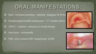  Hard / soft palate petechiae – transient –disappear 24-48 hrs
 Oropharyngeal tonsillar enlargement -- 2o to tonsillar abcess
 ANUG – common - refractory to normal therapy
 Oral ulcers – occasionally
 OHL: most common EBV related lesion in HIV
 