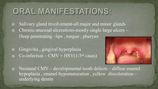 Salivary gland involvement-all major and minor glands
 Chronic mucosal ulcerations-mostly single large ulcers –
Deep penetrating –lips , tongue , pharynx
 Gingivitis , gingival hyperplasia
 Co-infection – CMV + HSV(1/3rd cases)
 Neonatal CMV – developmental tooth defects – diffuse enamel
hypoplasia , enamel hypomaturation , yellow discoloration –
underlying dentin
 
