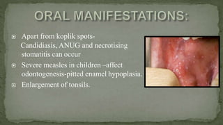 -
 Apart from koplik spots-
Candidiasis, ANUG and necrotising
stomatitis can occur
 Severe measles in children –affect
odontogenesis-pitted enamel hypoplasia.
 Enlargement of tonsils.
 