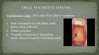 Forehheimer’s sign : 20 % cases 6 hrs after 1st symptom
 Dark red papules on soft palate, hard
palate along with rash
 Palatal petechiae
 1st month of pregnancy- hypoplasia,
caries, delayed eruption of decidous teeth
 