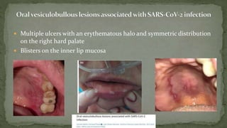  Multiple ulcers with an erythematous halo and symmetric distribution
on the right hard palate
 Blisters on the inner lip mucosa
 