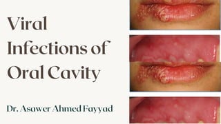 Viral infection of oral cavity..pptx