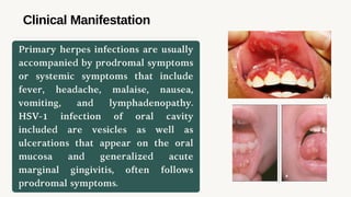 Systemic Hsv Viral infection of oral cavity .....pptx
