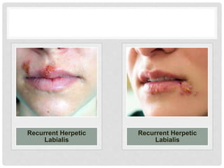 Recurrent Herpetic
Labialis
Recurrent Herpetic
Labialis
 