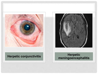 Herpetic conjunctivitis
Herpetic
meningoencephalitis
 