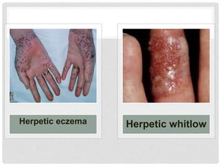 Herpetic eczema Herpetic whitlow
 