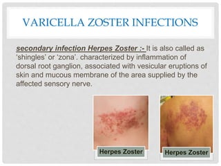 VARICELLA ZOSTER INFECTIONS
secondary infection Herpes Zoster :- It is also called as
‘shingles’ or ‘zona’. characterized by inflammation of
dorsal root ganglion, associated with vesicular eruptions of
skin and mucous membrane of the area supplied by the
affected sensory nerve.
Herpes Zoster Herpes Zoster
 