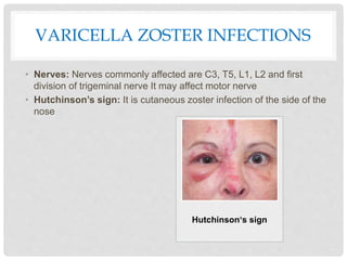VARICELLA ZOSTER INFECTIONS
• Nerves: Nerves commonly affected are C3, T5, L1, L2 and first
division of trigeminal nerve It may affect motor nerve
• Hutchinson’s sign: It is cutaneous zoster infection of the side of the
nose
Hutchinson‘s sign
 