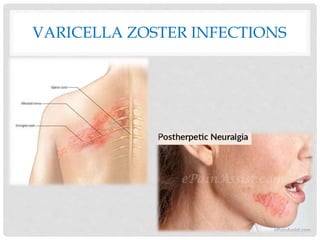 VARICELLA ZOSTER INFECTIONS
 