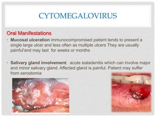 CYTOMEGALOVIRUS
Oral Manifestations
• Mucosal ulceration immunocompromised patient tends to present a
single large ulcer and less often as multiple ulcers They are usually
painful'and may last for weeks or months
• Salivary gland involvement: acute sialadenitis which can involve major
and minor salivary gland. Affected gland is painful. Patient may suffer
from xerostomia
 