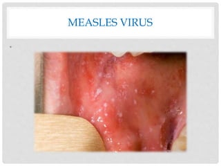 MEASLES VIRUS
•
 