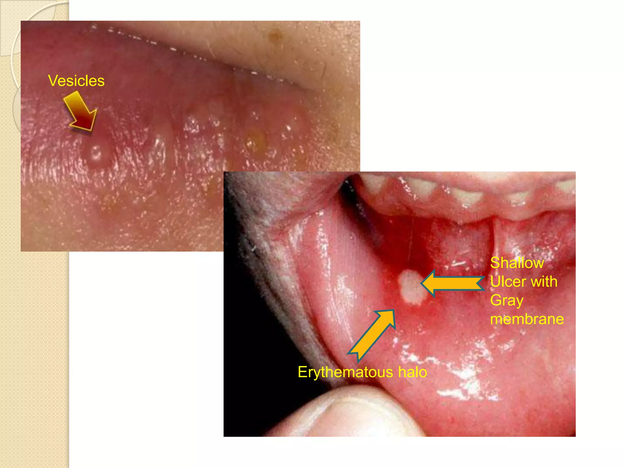 viral-infections-of-oral-cavity-pptx