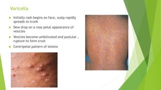 Varicella
 Initially rash begins on face, scalp rapidly
spreads to trunk
 Dew drop on a rose petal appearance of
vesicles
 Vesicles become umbilicated and pustular ,
rupture to form crust
 Centripetal pattern of lesions
 