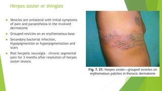 Herpes zoster or shingles
 Vesicles are unilateral with initial symptoms
of pain and paraesthesia in the involved
dermatome
 Grouped vesicles on an erythematous base
 Secondary bacterial infection,
Hypopigmention or hyperpigmentation and
scars
 Post herpetic neuralgia – chronic segmental
pain for 3 months after resolution of herpes
zoster lesions
 