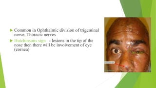  Common in Ophthalmic division of trigeminal
nerve, Thoracic nerves
 Hutchinsons sign - lesions in the tip of the
nose then there will be involvement of eye
(cornea)
 