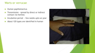Warts or verrucae
 Human papillomavirus
 Transmission – spread by direct or indirect
contact via fomites
 Incubation period - few weeks upto an year
 About 120 types are identified in human
 