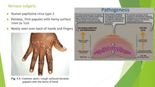 Verruca vulgaris
 Human papilloma virus type 2
 Painless, firm papules with horny surface
1mm to 1cm
 Mostly seen over back of hands and fingers
 