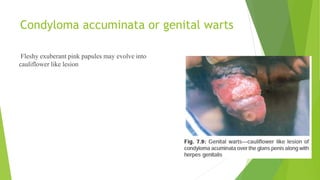 Condyloma accuminata or genital warts
Fleshy exuberant pink papules may evolve into
cauliflower like lesion
 