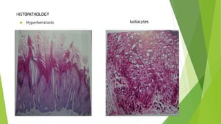  Hyperkeratosis
HISTOPATHOLOGY
koilocytes
 