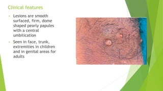 Clinical features
• Lesions are smooth
surfaced, firm, dome
shaped pearly papules
with a central
umbilication
• Seen in face, trunk,
extremities in children
and in genital areas for
adults
 