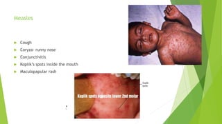 Measles
 Cough
 Coryza- runny nose
 Conjunctivitis
 Koplik’s spots inside the mouth
 Maculopapular rash
 