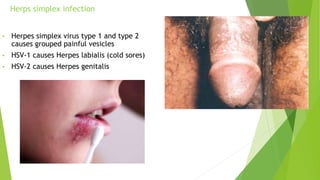 • Herpes simplex virus type 1 and type 2
causes grouped painful vesicles
• HSV-1 causes Herpes labialis (cold sores)
• HSV-2 causes Herpes genitalis
Herps simplex infection
 