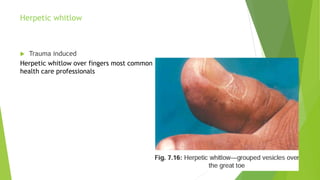 Herpetic whitlow
 Trauma induced
Herpetic whitlow over fingers most common
health care professionals
 