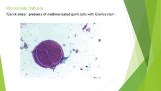 Microscopic features
Tzanck smear –presence of multinucleated gaint cells with Giemsa stain
 