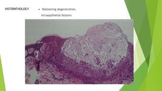  Ballooning degeneration,
intraepithelial blisters
HISTOPATHOLOGY
 
