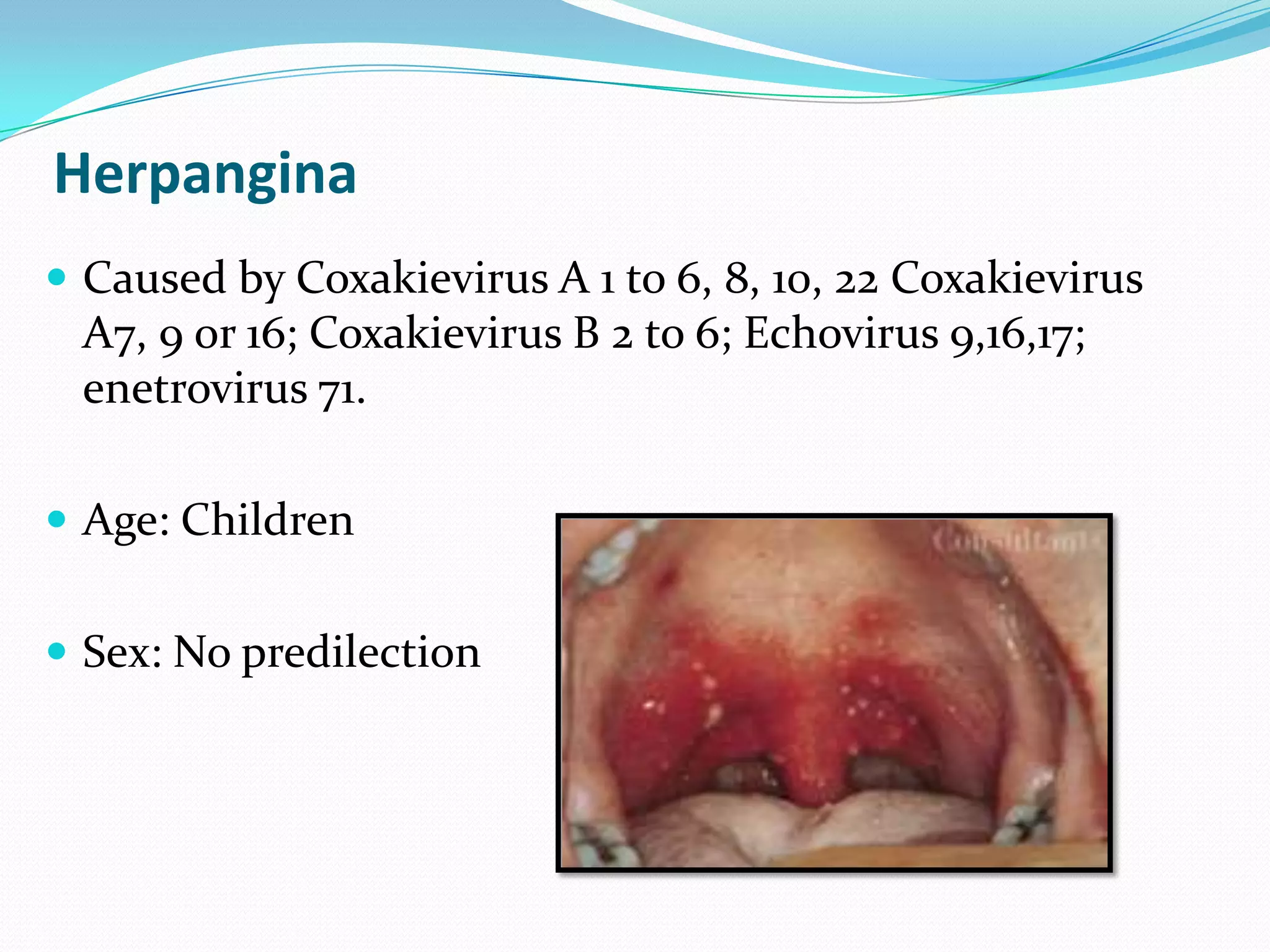 Viral infections of oral cavity - Dr. Abhishek Solanki | PPTX