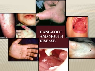 Viral infections (oral cavity) | PPTX