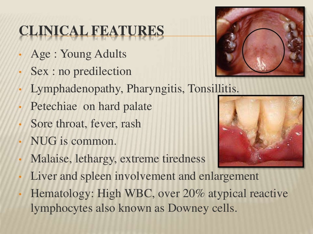 Viral infections (oral cavity)