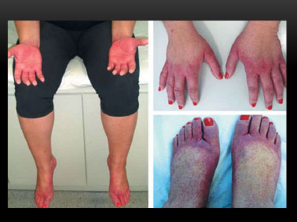 Viral infections ug lecture 2003