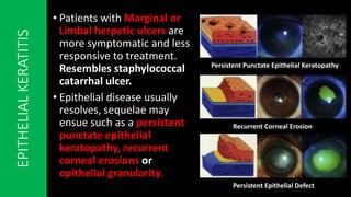Nummular Keratitis Nummular Keratitis