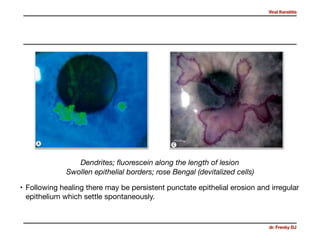 Viral Keratitis
dr. Frenky DJ
• Following healing there may be persistent punctate epithelial erosion and irregular
epithelium which settle spontaneously.
Dendrites; ﬂuorescein along the length of lesion
Swollen epithelial borders; rose Bengal (devitalized cells)
 