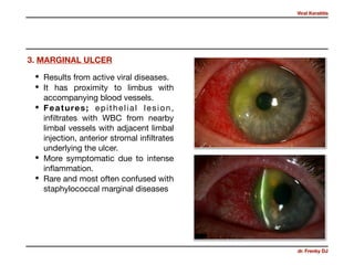 Viral Keratitis
dr. Frenky DJ
• Results from active viral diseases. 

• It has proximity to limbus with
accompanying blood vessels. 

• Features; epithelial lesion,
inﬁltrates with WBC from nearby
limbal vessels with adjacent limbal
injection, anterior stromal inﬁltrates
underlying the ulcer.

• More symptomatic due to intense
inﬂammation. 

• Rare and most often confused with
staphylococcal marginal diseases
3. MARGINAL ULCER
 