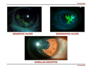 Viral Keratitis
dr. Frenky DJ
GEOGRAPHIC ULCERDENDRITIC ULCER
NUMULAR KERATITIS
 