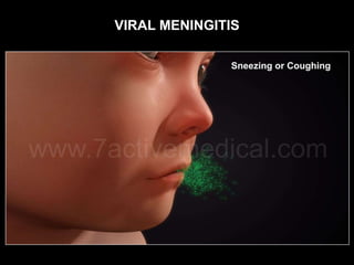 VIRAL MENINGITIS
 