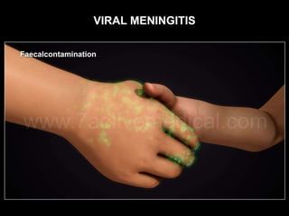 VIRAL MENINGITIS
 