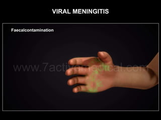 VIRAL MENINGITIS
 